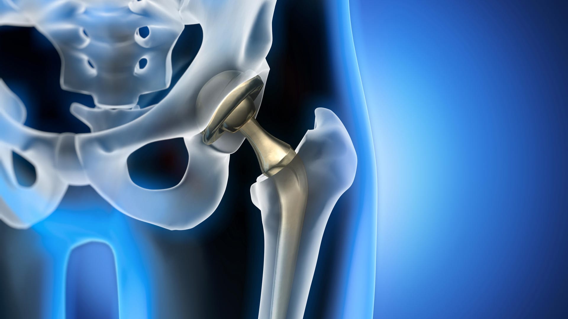 Grafische Darstellung eines Hüftimplantats. Bei der Entscheidung für ein künstliches Hüftgelenk spielt der Zeitpunkt eine wichtige Rolle. Denn der Gelenkersatz hält meist nur 20 bis 25 Jahre.