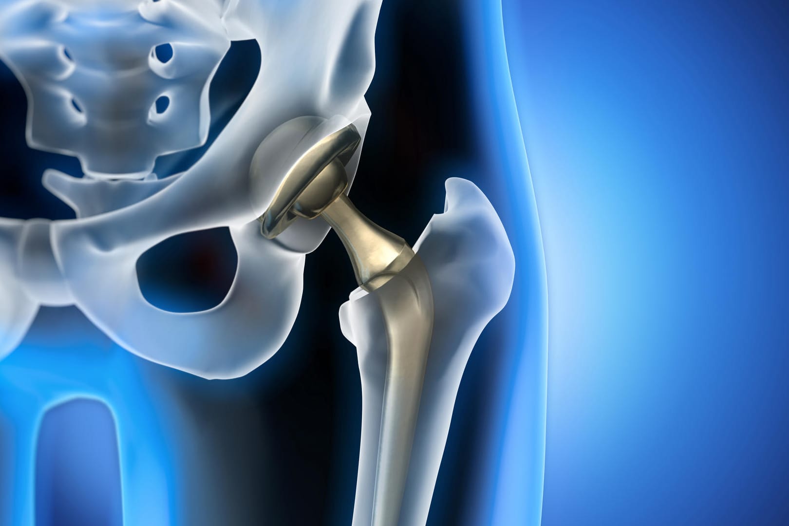 Grafische Darstellung eines Hüftimplantats. Bei der Entscheidung für ein künstliches Hüftgelenk spielt der Zeitpunkt eine wichtige Rolle. Denn der Gelenkersatz hält meist nur 20 bis 25 Jahre.