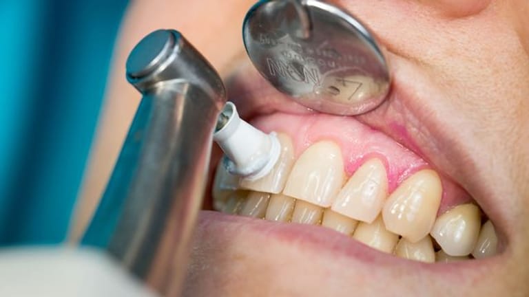 Regelmäßige professionelle Zahnreinigungen beugen Zahnfleischproblemen vor.