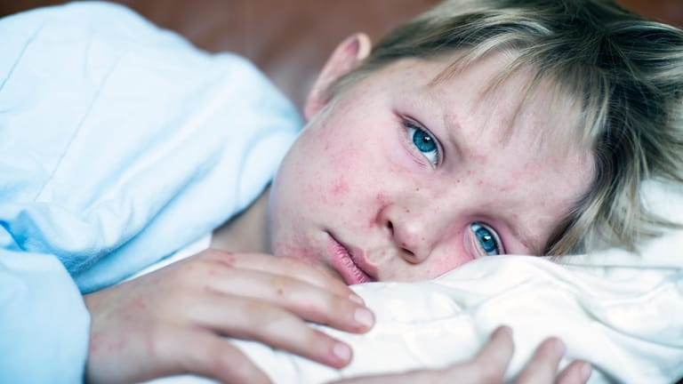 Junge mit Masern: Der Masernausschlag ist eines der typischen Symptome der Erkrankung.