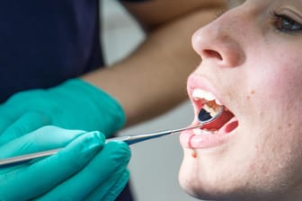 Parodontitis: Die Entzündung des Zahnbetts kann auf lange Sicht zum Verlust von Zähnen führen.