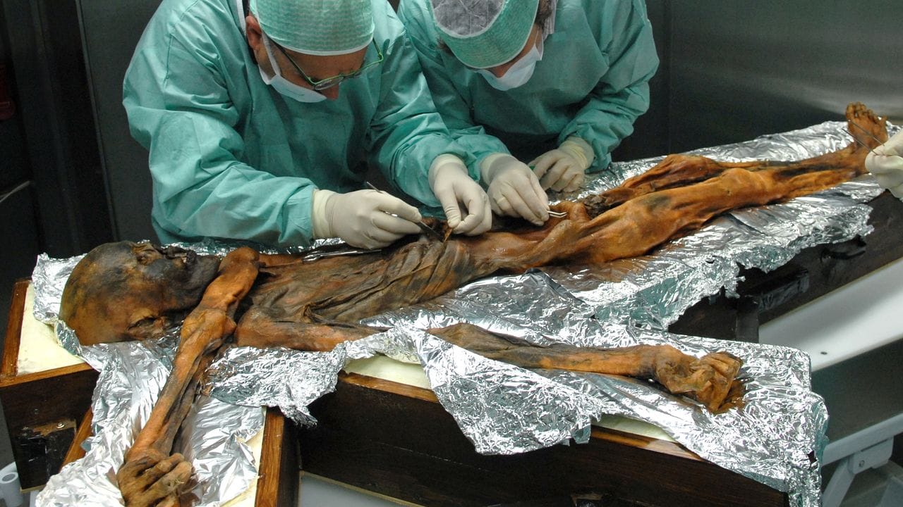 Wissenschaftler untersuchen in Bozen die rund 5000 Jahre alte Gletschermumie "Ötzi" und entnehmen Proben des Mageninhaltes.