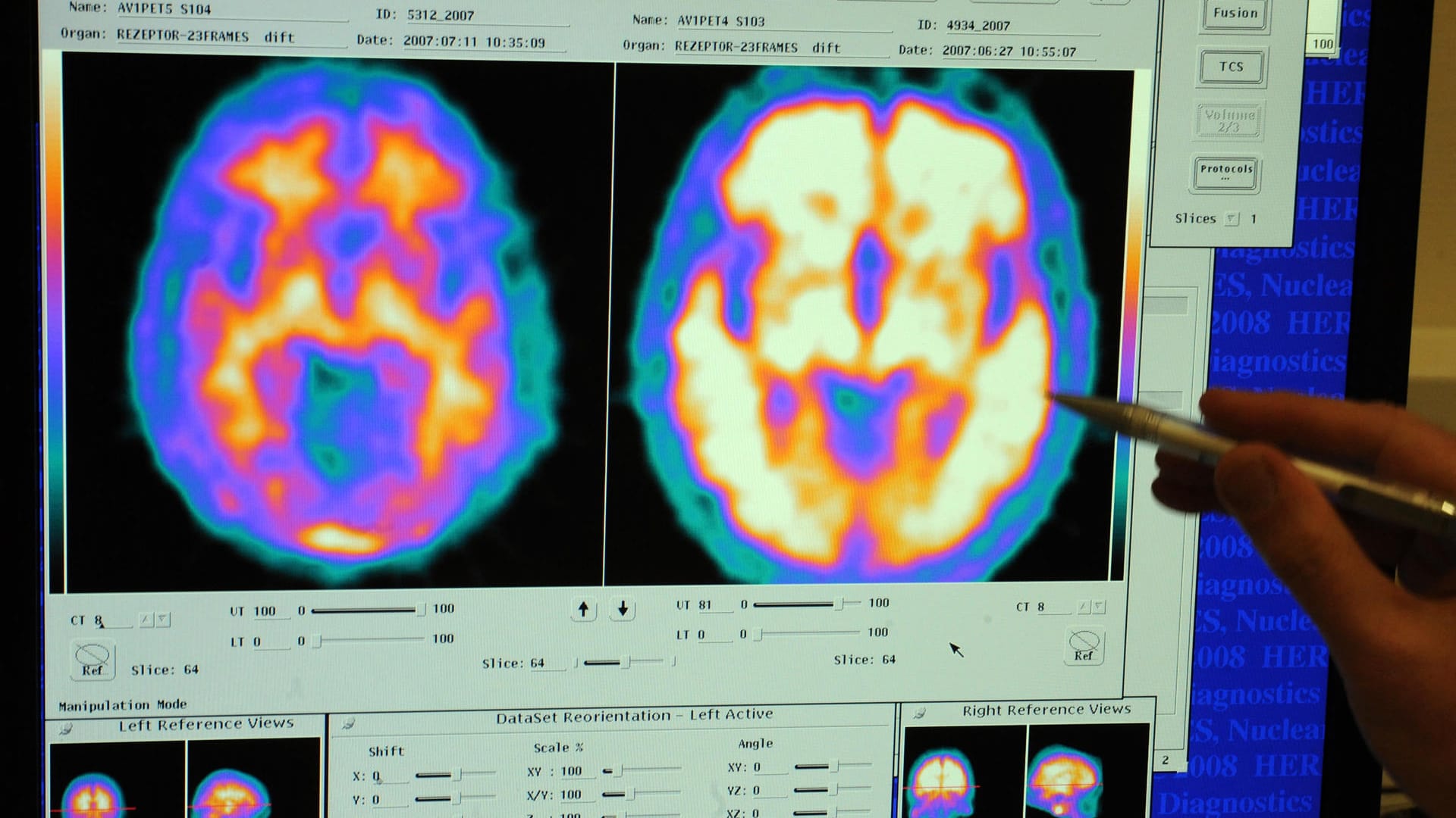 Magnetresonanztomographie zeigt aktive Bereiche im Gehirn an