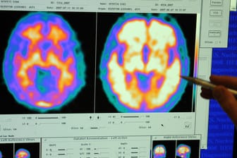 Magnetresonanztomographie zeigt aktive Bereiche im Gehirn an