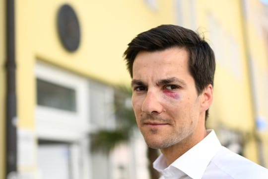 Freiburgs frische gewähltem Oberbürgermeister Martin Horn war bei seiner Wahlparty mit voller Wucht ins Gesicht geschlagen worden.