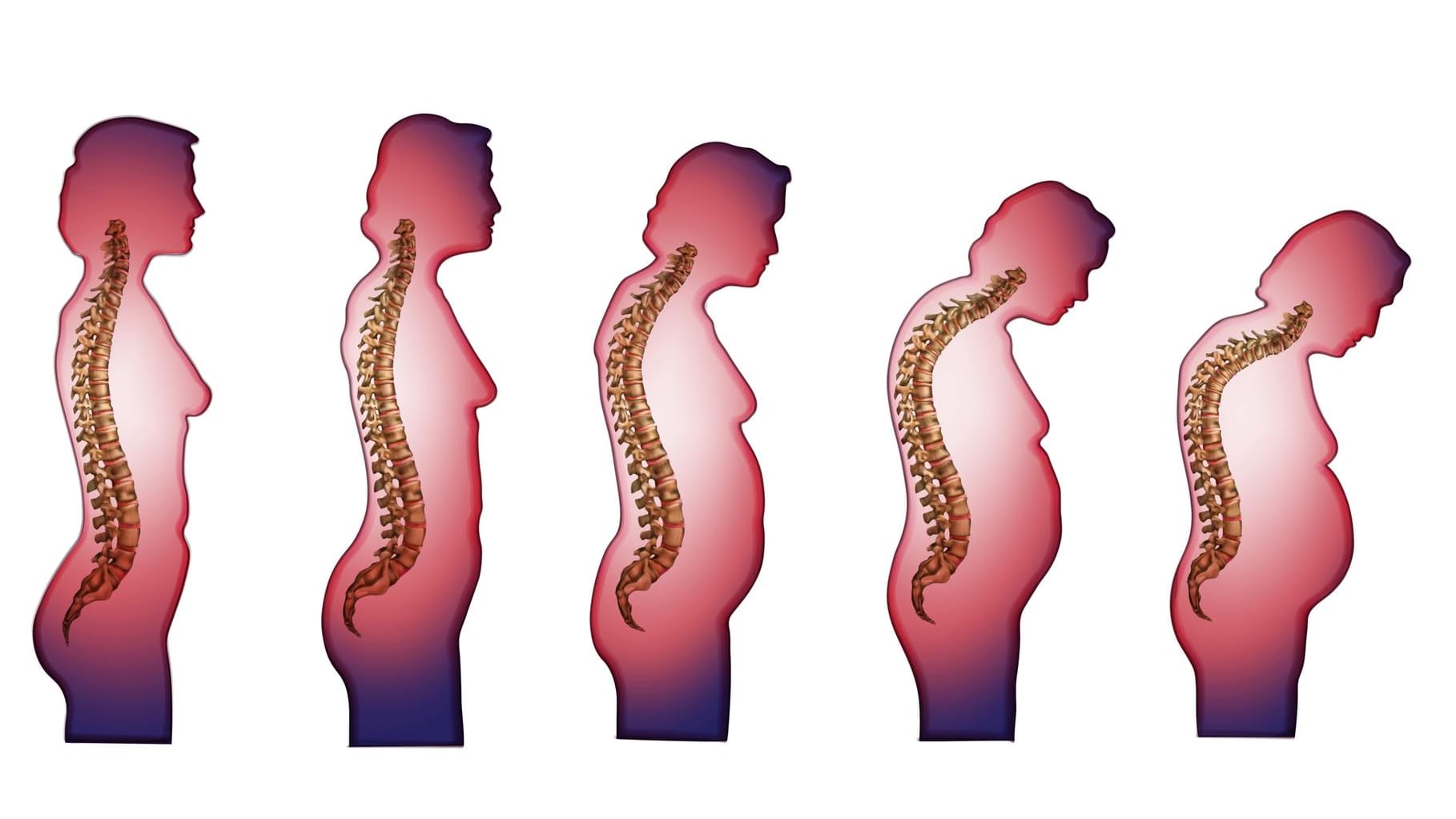 Die Grafik zeigt, wie sich die Wirbelsäule mit zunehmendem Alter verformt.