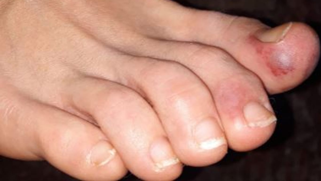 Hautirritationen an den Füßen: Die Flecken sind zunächst rot-violett, können sich später jedoch verkrusten.