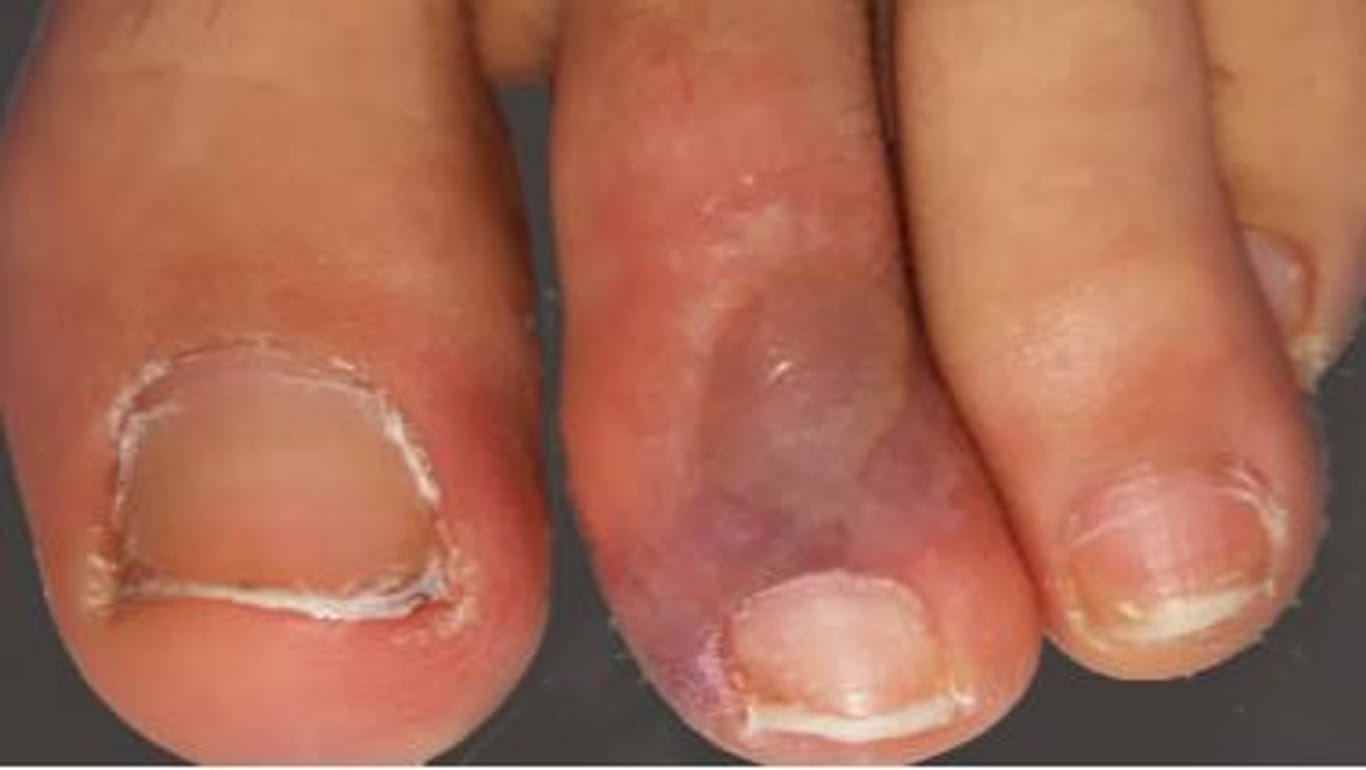 Flecken an den Füßen: In einigen Fällen haben sich aus den Flecken schmerzhafte Blasen entwickelt.