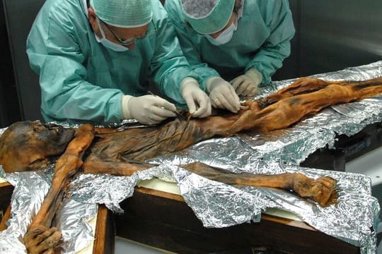 Wissenschaftler untersuchen in Bozen die rund 5000 Jahre alte Gletschermumie "Ötzi" und entnehmen Proben des Mageninhaltes.