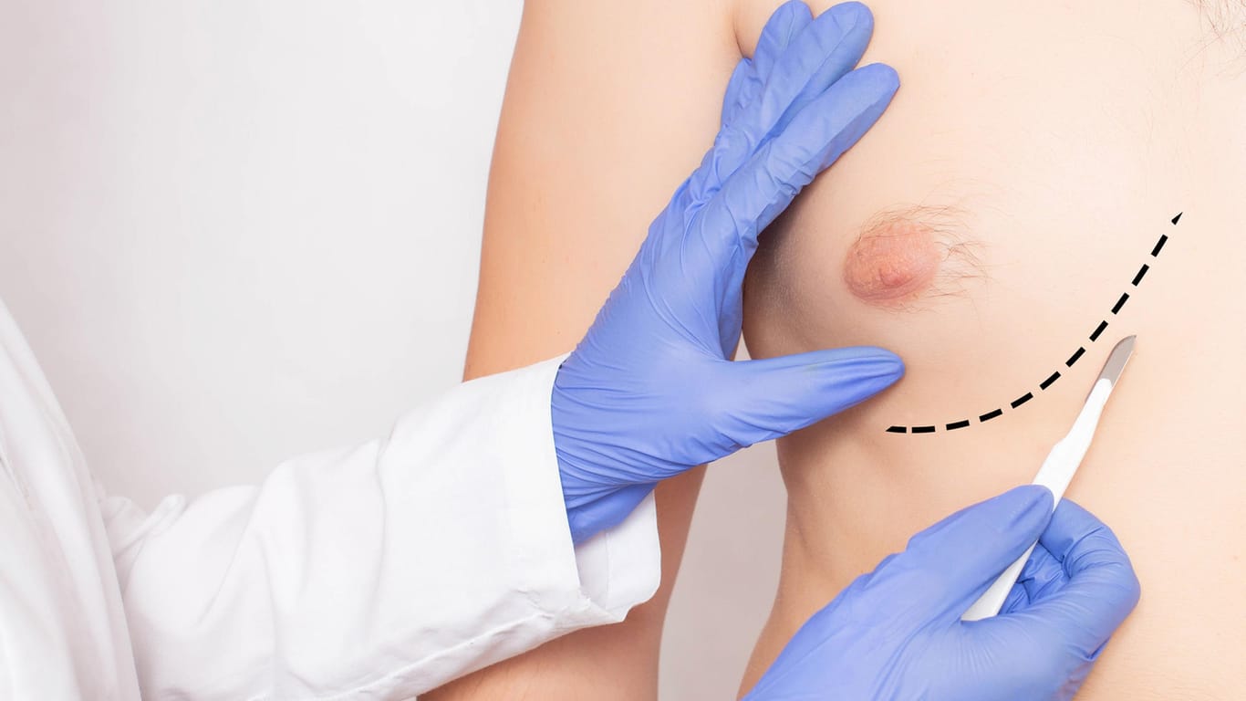 Ein Chirurg markiert die Brust eines männlichen Patienten. Auch Brustkrebs kann in seltenen Fällen Männer treffen.
