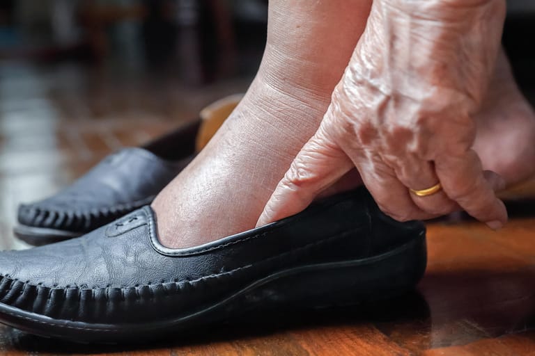 Eine ältere Frau mit geschwollen Füßen zieht sich einen Schuh an. Diabetiker sollten achtsam mit ihren Füßen umgehen und schon bei kleinen Veränderungen einen Arzt aufsuchen.