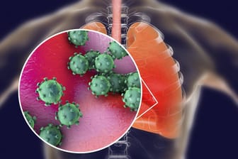 Viren in der Lunge (Symbolbild): Auffallend viele Kinder machen seit einigen Wochen Atemwegsinfekte durch.