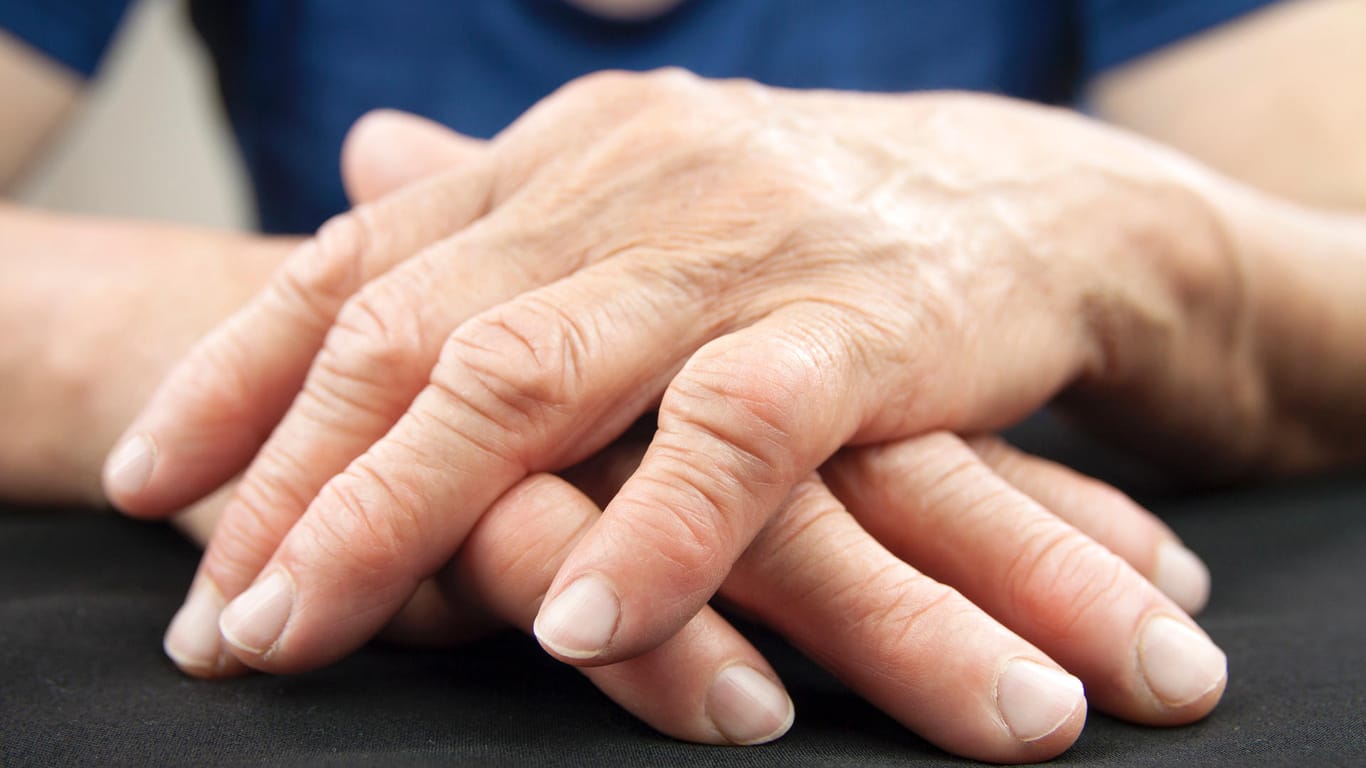 Durch Rheuma verformte Hände: Bei fortgeschrittener Arthritis kann es zu dauerhaften Fehlstellungen der Gelenke kommen.