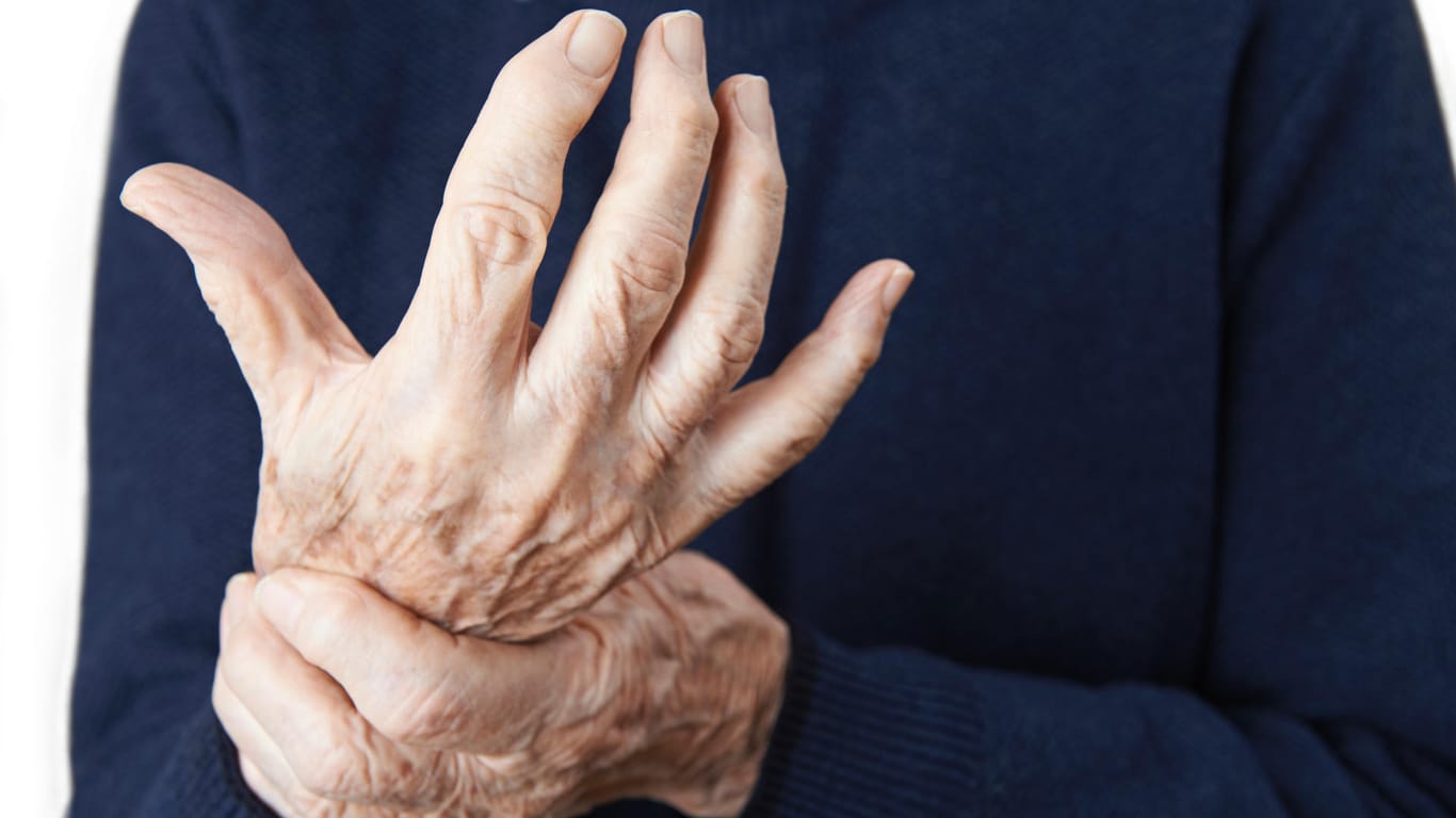 Arthritisch verformte Finger: Rheuma kann nicht nur Gelenkbeschwerden hervorrufen, sondern auch Rheumaknoten.