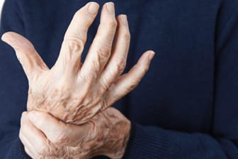 Arthritisch verformte Finger: Rheuma kann nicht nur Gelenkbeschwerden hervorrufen, sondern auch Rheumaknoten.