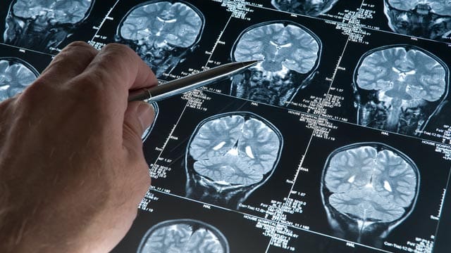 Alzheimer: Viele Menschen haben Angst, im Alter an Alzheimer zu erkranken.