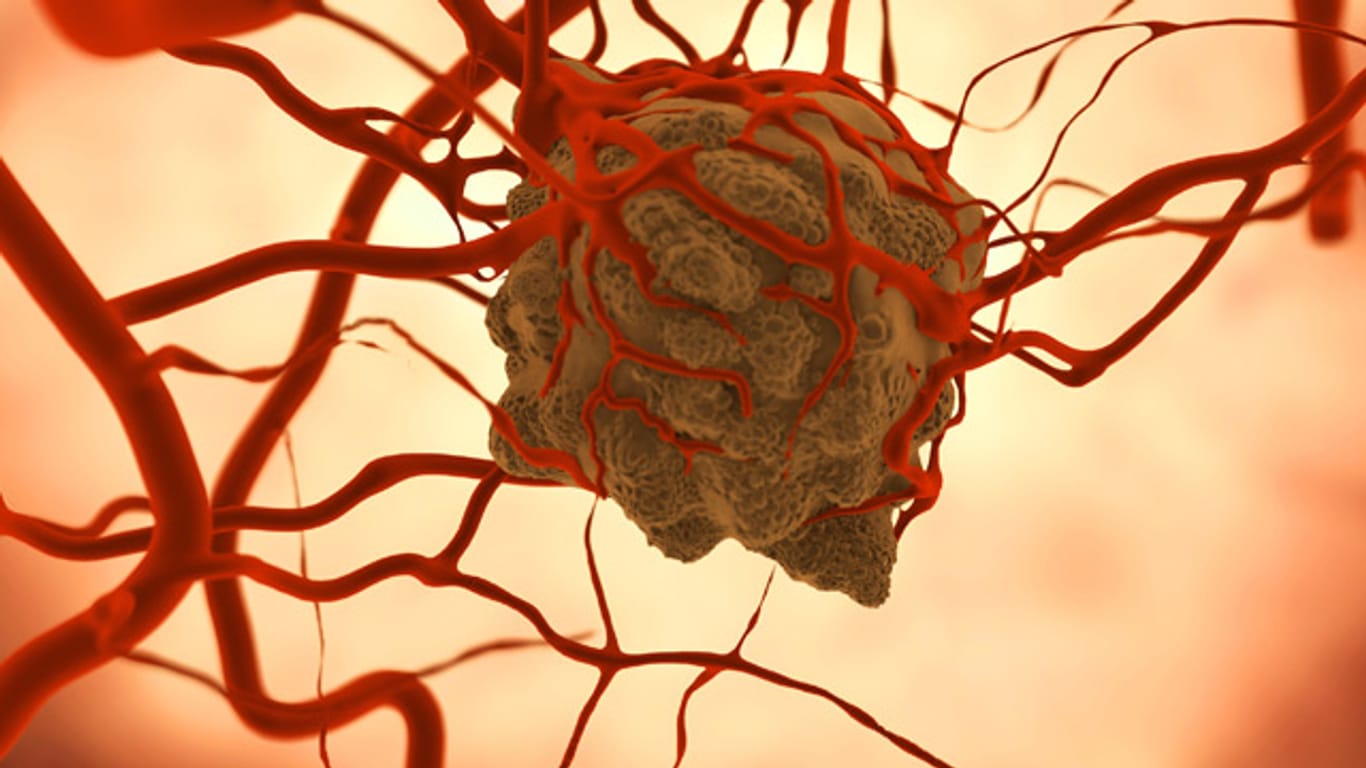 Tumorzelle: Warum sich Geschwülste bilden, ist wissenschaftlich nicht abschließend geklärt.