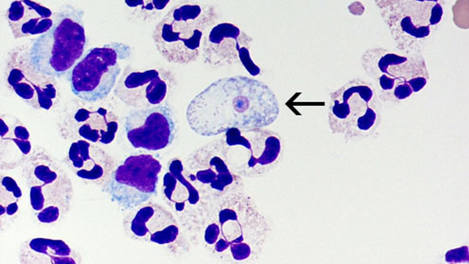 "Naegleria fowleri" unter dem Mikroskop: Die Amöben dringen ins Gehirn ein.