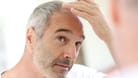 Genetisch bedingter Haarausfall ist vor allem bei Männern weit verbreitet. Eine Haartransplantation hilft, kahle Stellen und Geheimratsecken wieder zu füllen.