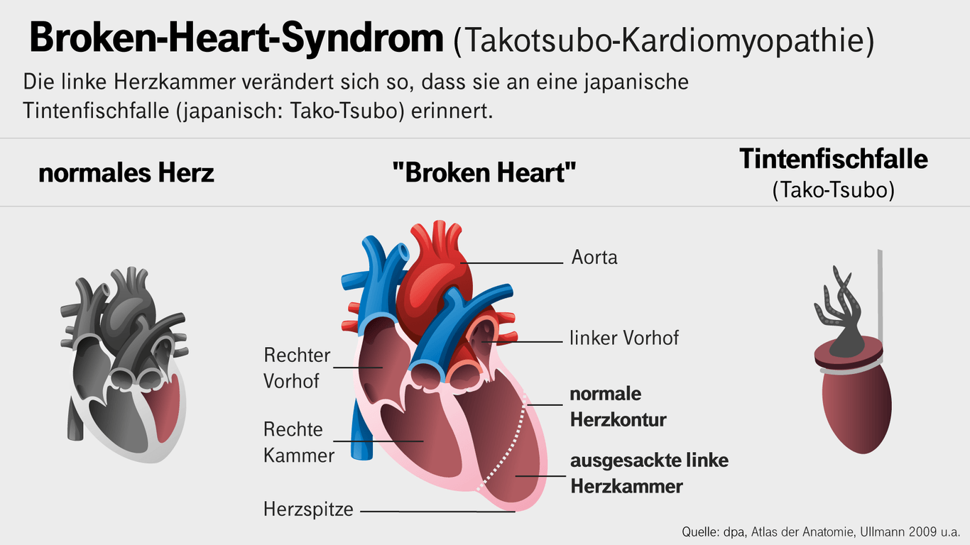 Grafik Broken-Heart-Syndrom