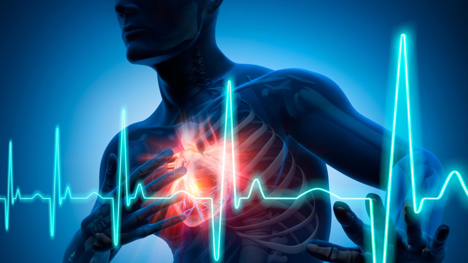 Eine instabile Angina Pectoris kann der Vorbote eines Herzinfarkts sein.