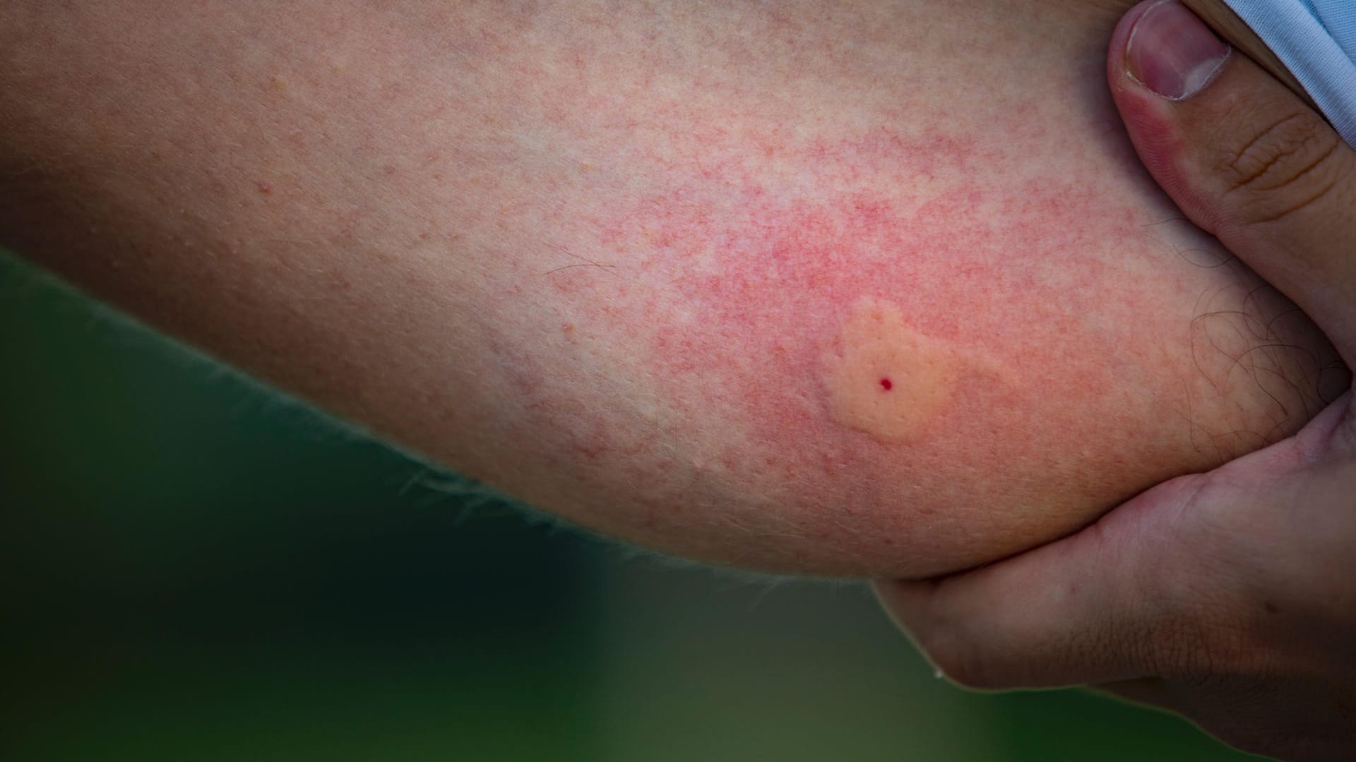 Stechmücke: Stich erzeugt juckende Quaddeln mit hellem Mittelpunkt.