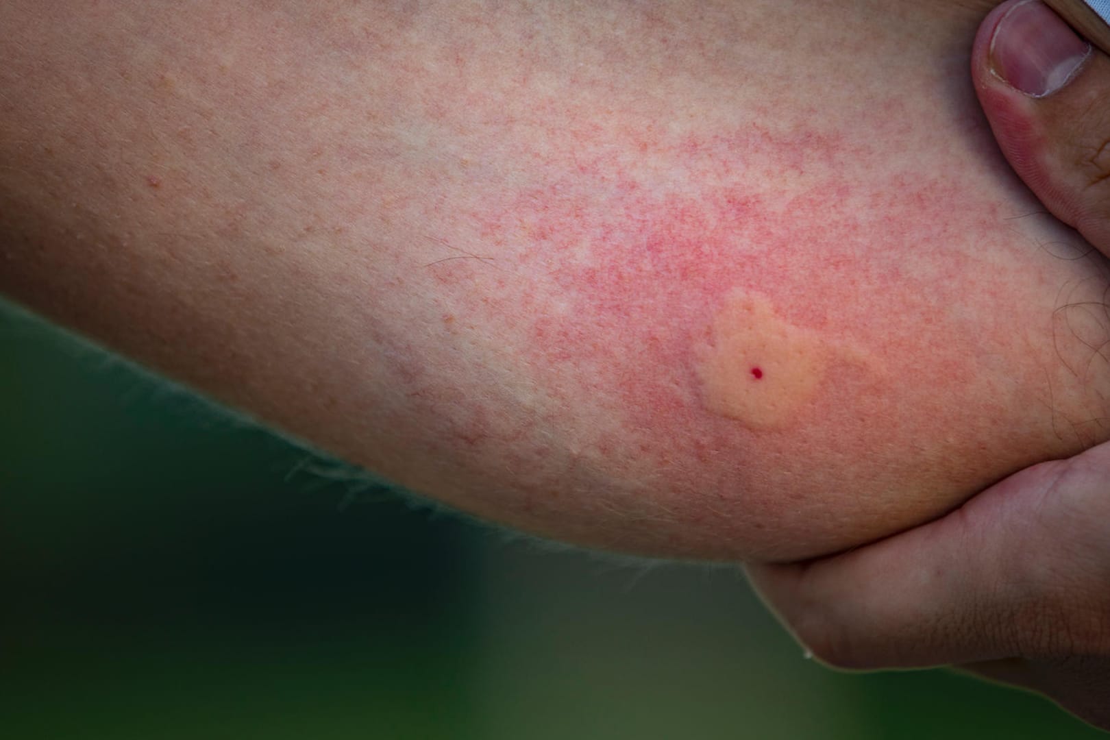 Stechmücke: Stich erzeugt juckende Quaddeln mit hellem Mittelpunkt.