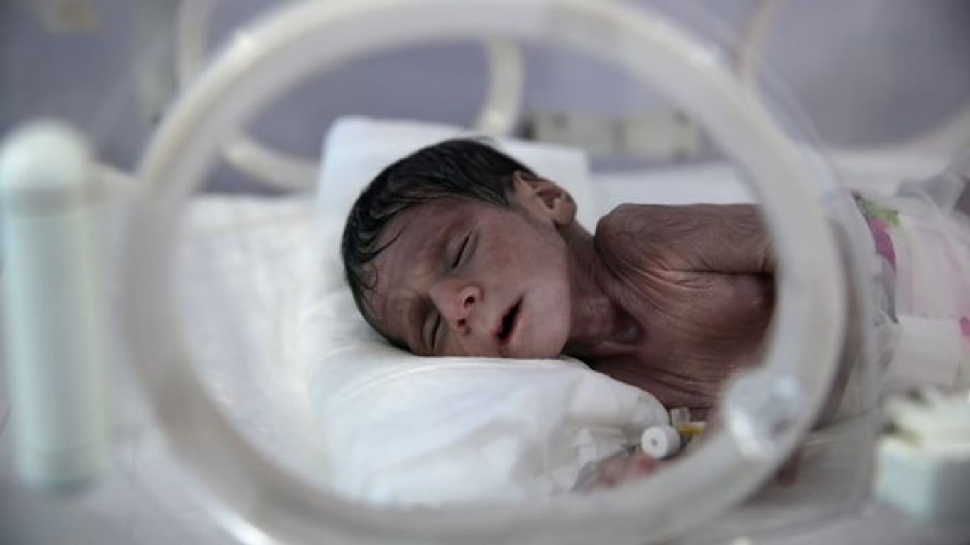 Ein unterernährtes Neugeborenes liegt in einem Krankenhaus in Sanaa.