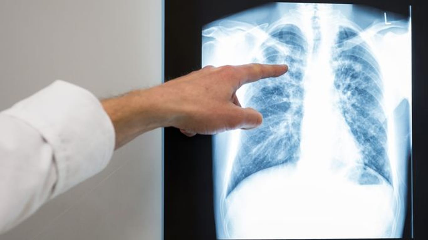 Röntgenbild einer Lunge im Vivantes Klinikum Neukölln.