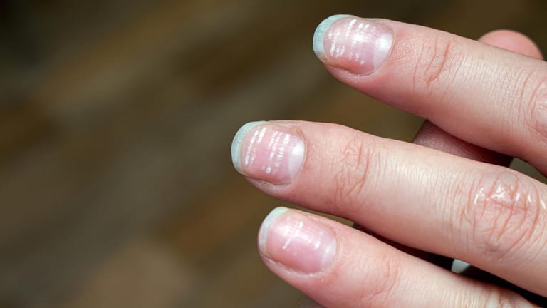 Veränderungen der Fingernägeln können ein Hinweis darauf sein, dass Eisen oder andere Mineralstoffe dem Körper fehlen.