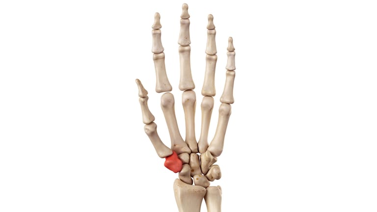 Das Vieleckbein (Os trapezium): Bei einer fortgeschrittenen Rhizarthrose kann es sinnvoll sein, den Knochen zu entfernen.