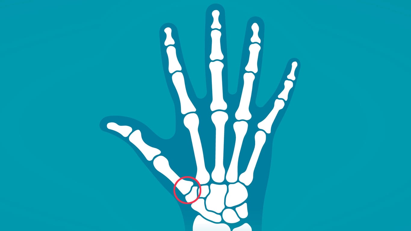 Daumensattelgelenk: Bei einer Rhizarthrose ist das Gelenk zwischen dem Handwurzelknochen und dem benachbarten Mittelhandknochen des Daumens verschlissen.
