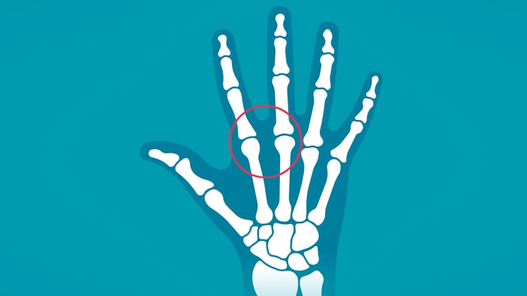 Darstellung der Fingergelenke: Bei einer Hämochromatose können Gelenkschmerzen auftreten – die Symptome zeigen sich vor allem im zweiten und dritten Fingergrundgelenk.