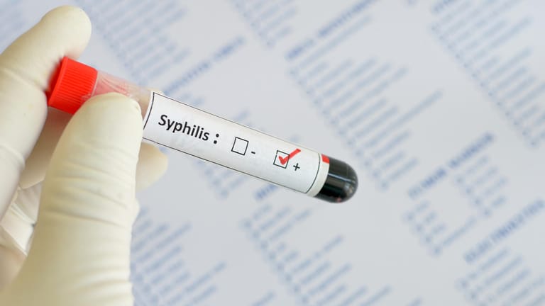 Eine Blutprobe mit einem positiven Syphilis-Ergebnis.