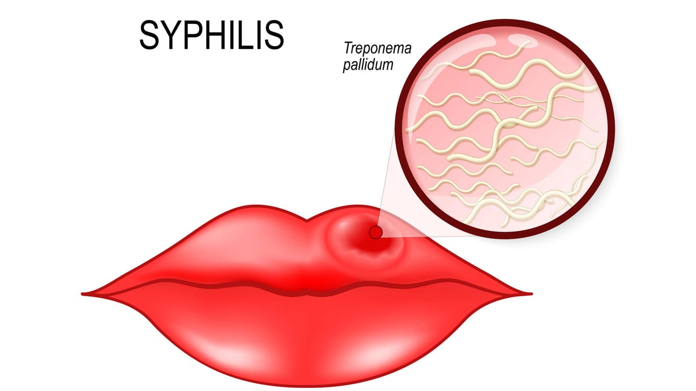 Syphilisgeschwür an der Lippe:
