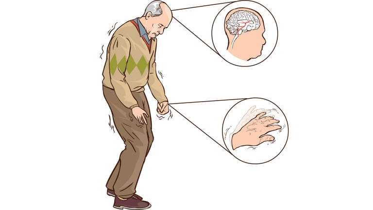 Illustration: Einschränkungen durch Parkinson