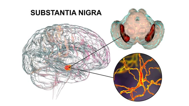 Illustration: Gehirnveränderungen bei Morbus Parkinson