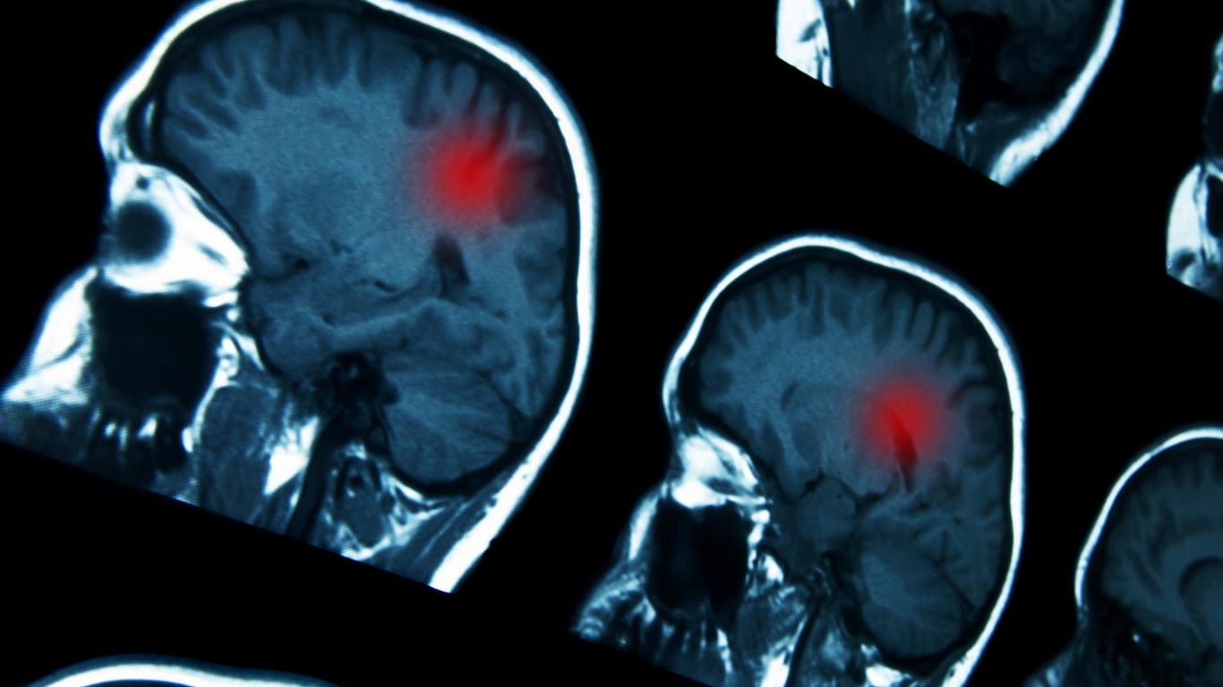 Darstellung des Gehirns in einer Magnetresonanztomografie (MRT); Das bildgebende Verfahren wird bei der Diagnose von Hirntumoren eingesetzt.