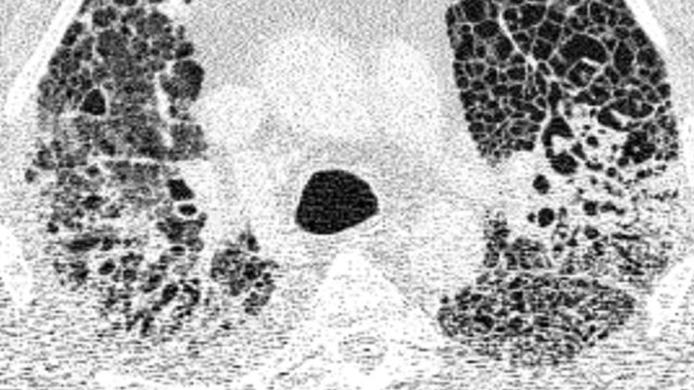 Computertomographie-Aufnahme (CT-Bild) der Lunge eines Patienten mit COVID-19-Lungenversagen.