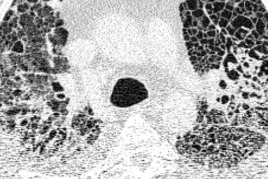 Computertomographie-Aufnahme (CT-Bild) der Lunge eines Patienten mit COVID-19-Lungenversagen.