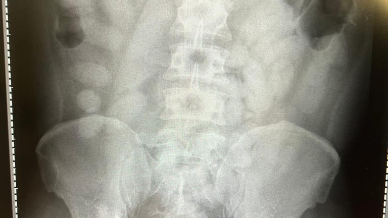 Röntgenbild des Körperschmugglers: Mehr als ein Kilogramm Kokain wurde in 72 Bodypacks im Magen des Mannes entdeckt.