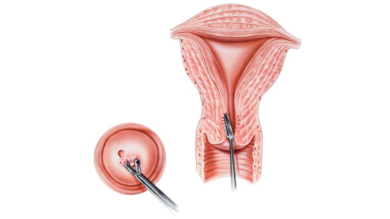 Darstellung einer Biopsie am Gebärmutterhals