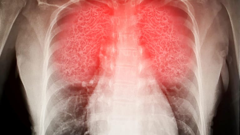 Scan einer Lunge (Symbolbild): Die Spätfolgen einer durchgemachten Infektion mit dem Coronavirus können sämtliche Organe betreffen.