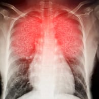 Scan einer Lunge (Symbolbild): Die Spätfolgen einer durchgemachten Infektion mit dem Coronavirus können sämtliche Organe betreffen.