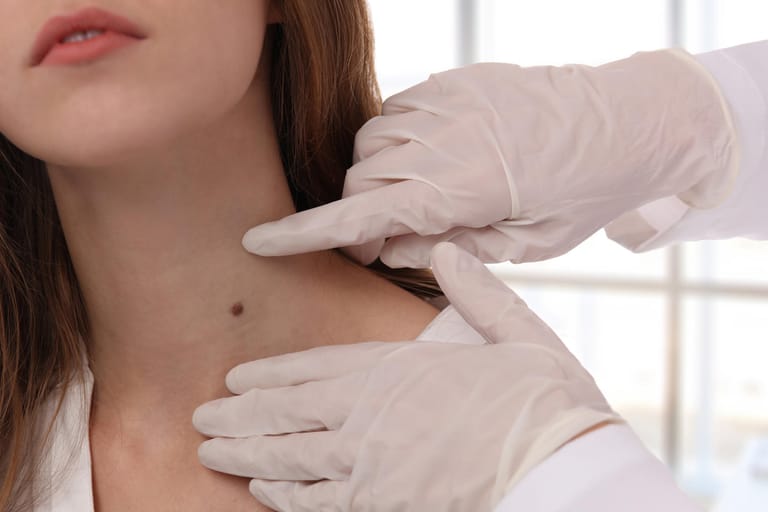 Hautkrebs tritt häufig im Halsbereich auf. Wird er frühzeitig erkannt, lässt er sich dank neuer Verfahren oft gut behandeln.