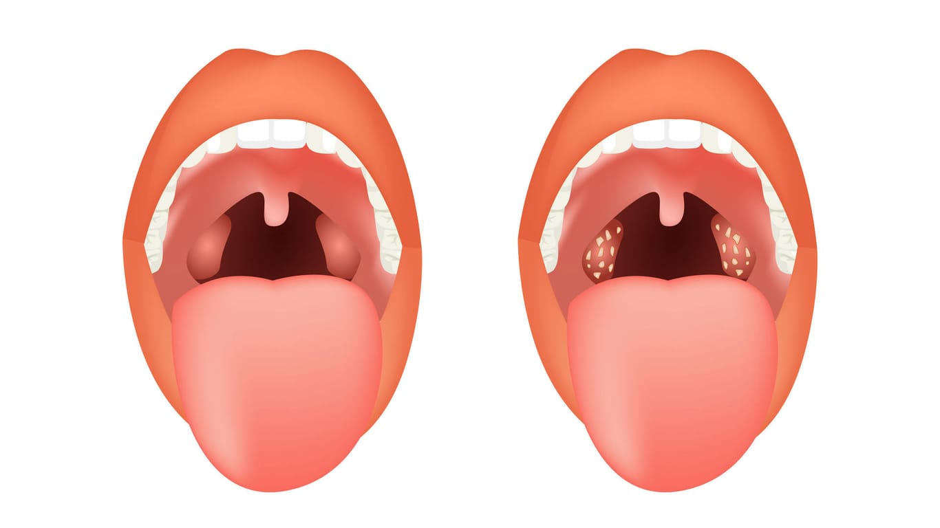 Geöffneter Mund mit Gaumenmandeln
