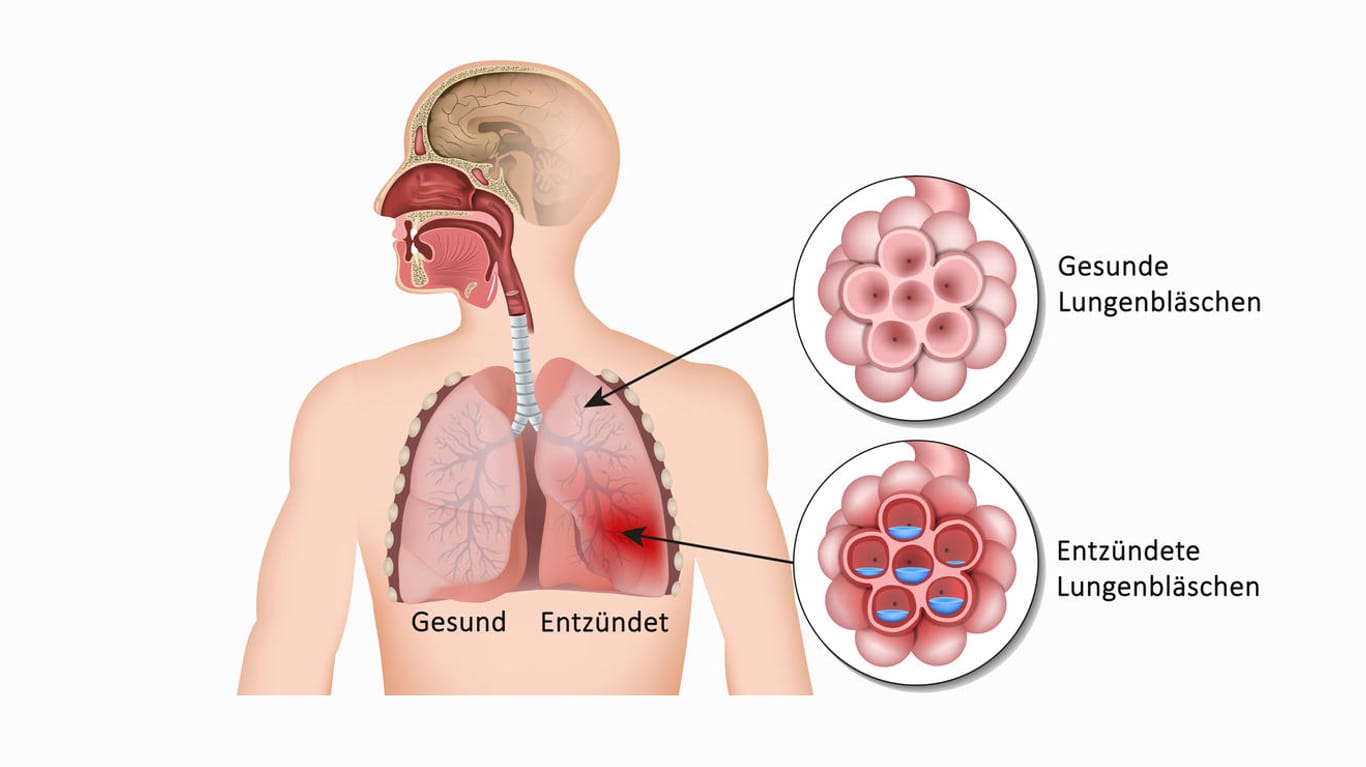 Grafische Darstellung von gesunder Lunge und Lunge mit Lungenentzündung