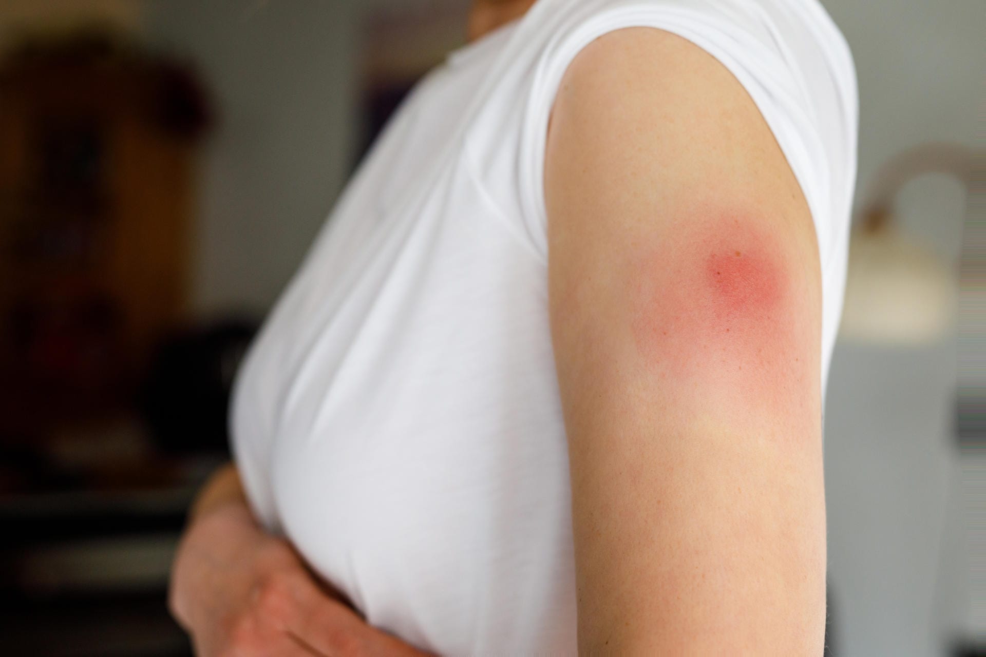 Die häufigste Impfreaktion sind Schmerzen und Rötungen an der Einstichstelle – auch als "Covid-Arm" bekannt.