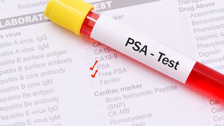PSA-Test: Er soll helfen, Prostatakrebs zu entdecken, bevor er Beschwerden verursacht. Doch das Verfahren hat Vor- und Nachteile.