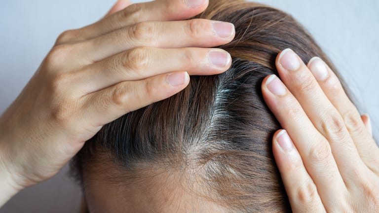 Frau fasst sich wegen Haarausfall an die: Durch eine erbliche Veranlagung entsteht eine Überempfindlichkeit der Haarfollikel gegenüber männlichen Sexual-Hormonen. Wenn weniger der männliche Sexual-Hormone in weibliche umgewandelt werden, verringert sich der Anteil an weiblichen, haarwuchsfördernden Hormonen wie Östrogen. Dadurch kann es bei Frauen zu Haarverlust kommen.